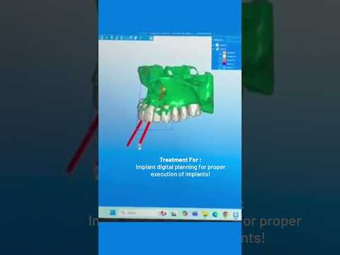 Implant Digital Planning | Better Planning. Precise Execution | Dr Namratha Umesh 