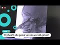 Wow: jongen overleeft ongeluk met mes in zijn hoofd