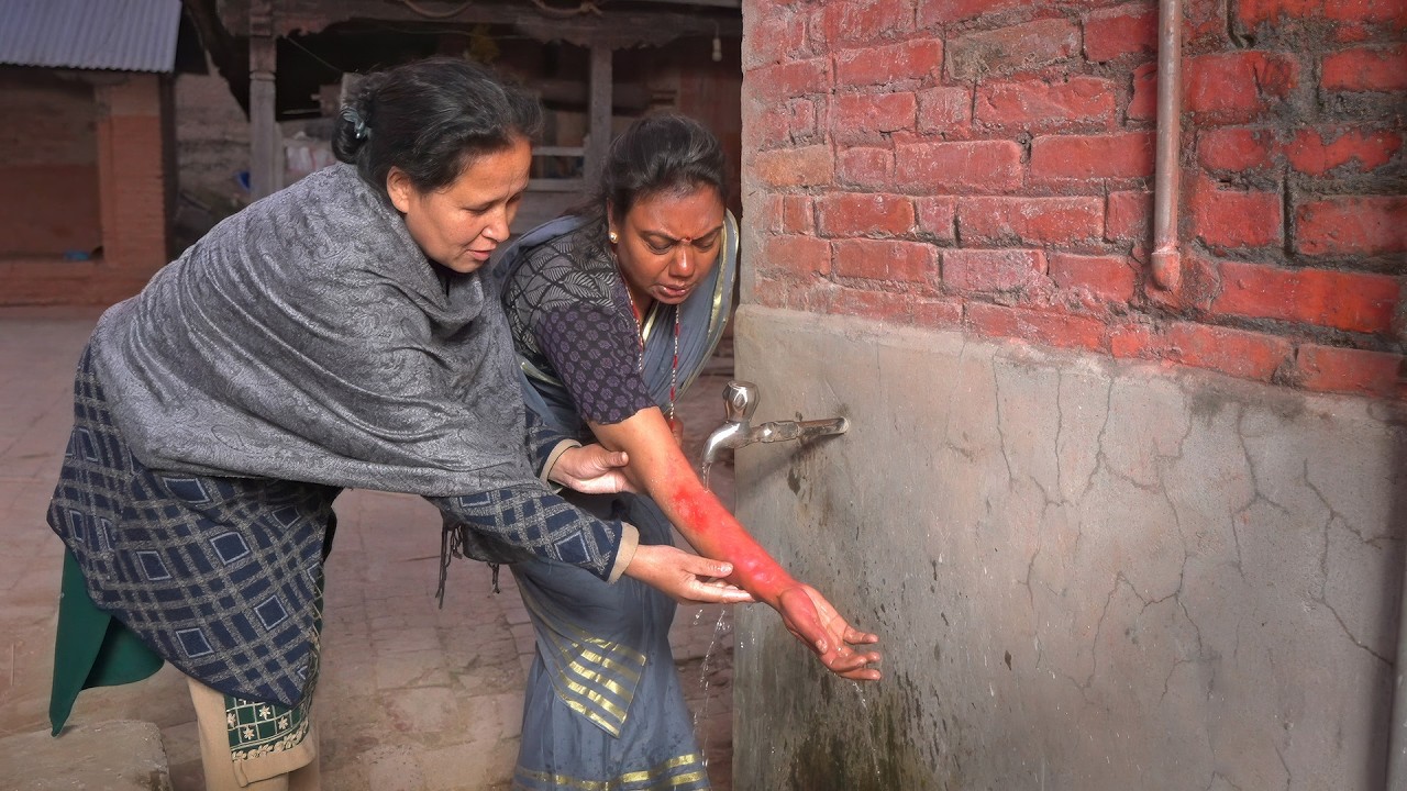 When to Go to the Hospital for a Burn (Kyrgyz) - Emergency Care Series