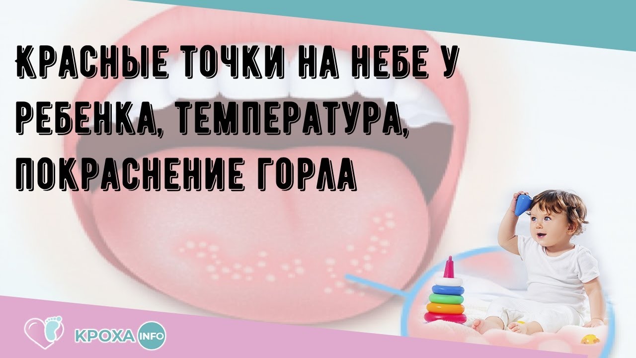 Красные точки на небе у ребенка, температура, покраснение горла