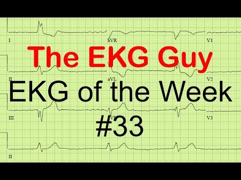 EKG/ECG of the Week #33 | The EKG Guy - www.ekg.md