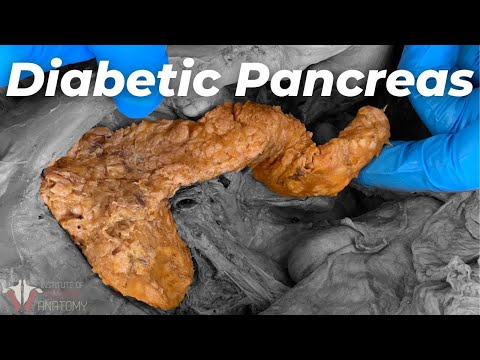 What Diabetes Does to the Body | Can You Reverse It?