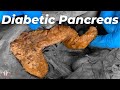 What Diabetes Does To The Body Can You Reverse It