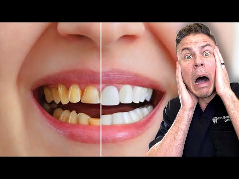 How You Are Whitening Your Teeth The WRONG Way!