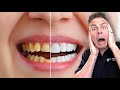 How You Are Whitening Your Teeth The WRONG Way