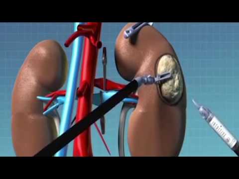 The Kidney and Kidney Cancers | UCLA Urology