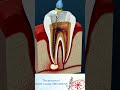 Root Canal Treatment & Tooth Abscess