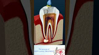 Root Canal Treatment &amp; Tooth Abscess