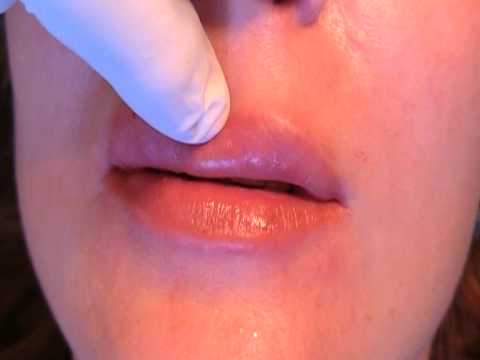 széklet szaga a száj okából és kezeléséből)