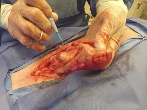 Bovie® Animal Health - Electrosurgery for Resection of an Insulinoma Tumo