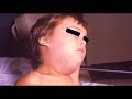mumps vaccine