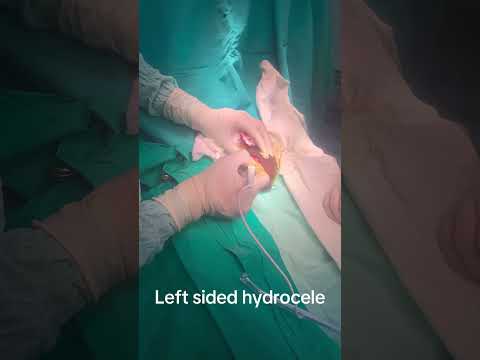 Jabouley’s repair for left sided hydrocele #hydroceletreatment #hydrocele #jabouley #surgery