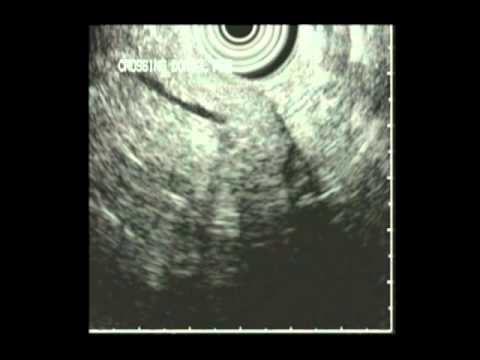 Pancreas divisum:  crossed duct sign