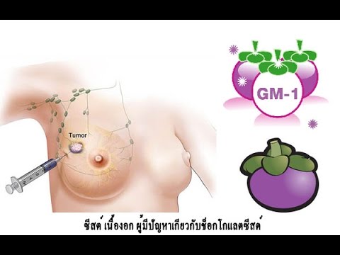 ทั้งสองคนถึง 45 ปีเพื่อเพิ่มความแข็งแรง ปลิงจุดแรง