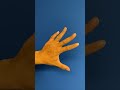 Metacarpal Fracture: After - Patient 3