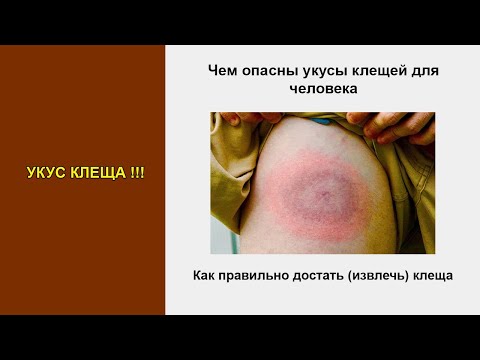 Что делать если клещ укусил человека. Действия при укусе клеща: как достать и чем обработать укус