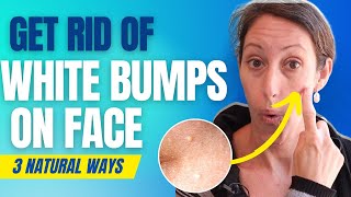 How to Get Rid of Mila | Natural Treatment for Milia - Pesky White Bumps on Your Face
