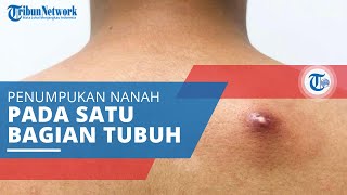 Abses, Penumpukan Nanah di Bagian Tubuh Tertentu Ditandai dengan Bejolan di Permukaan Kulit