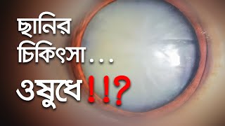 চোখের ছানির চিকিৎসা | Cataract Treatment | Dr. S. Rahman | Glaucoma & Refractive Surgeon