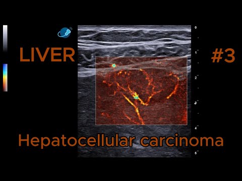 Hepatocellular carcinoma - Heterogeneous nodular lesions  video preview