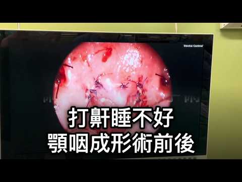懸吊式顎咽成形術手術前後對比