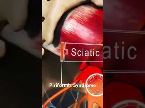 Piriformis Syndrome