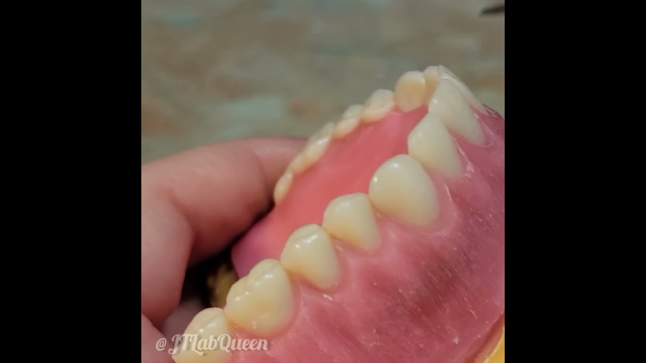 Maxillary Denture Wax up