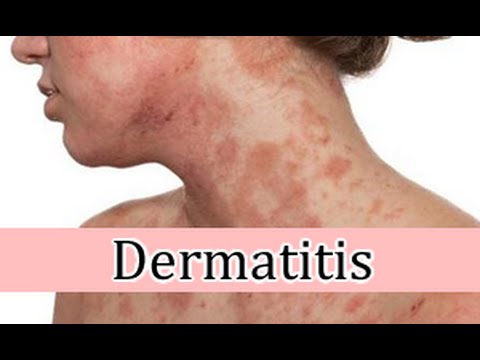 Unguento di eczema inglese Metodo buteyko a psoriasi