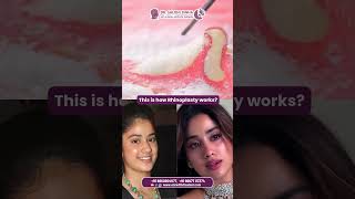 This is how Rhinoplasty works