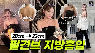 [팔뚝 지방흡입] 팔뚝둘레 28cm에서 22cm로!