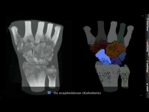 Wie man die Banken in Osteochondrose setzen Dysplasie des Kniegelenks mit einer verrenkten Kniescheibe