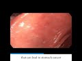 H Pylori Gastritis Endoscopy