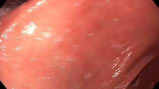 Download lagu H. Pylori Gastritis Endoscopy mp3 Download lagu H. Pylori Gastritis Endoscopy mp3