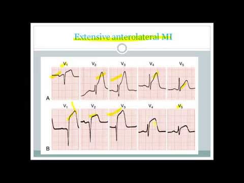 ECG changes in MI made easy