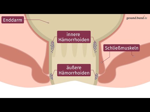 What are hemorrhoids?