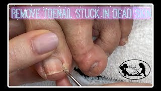 Pedicure Tutorial: How to Remove Toenail Stuck in Embedded Sidewall Dead Skin