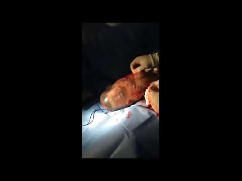 Dziecko przyszło na świat w worku owodniowym