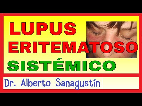 LUPUS ERITEMATOSO SISTÉMICO (LES) Síntomas, Fisiopatología y Tratamiento.