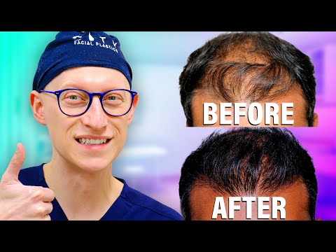 Best Hair Transplant Recovery