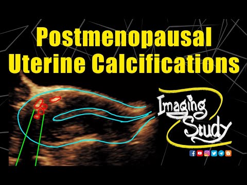 Postmenopausal Uterine Calcification || Ultrasound || Case 227