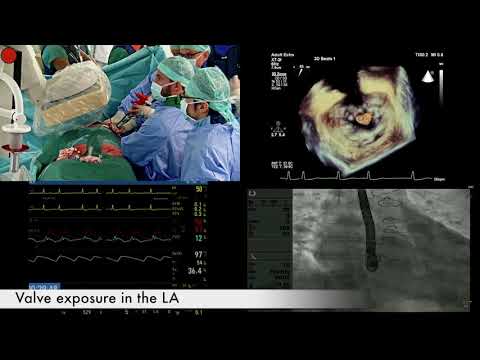 Asvide: Tendyne-Valve