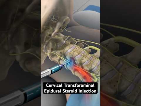 Using steroids to relieve neck pain (3D Animation)