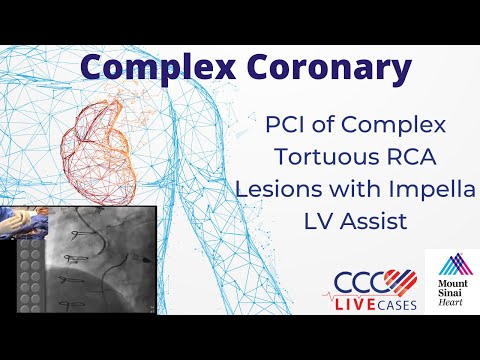 PCI of Complex Tortuous RCA Lesions with Impella LV Assist - October 16, 2012 Webcast Video