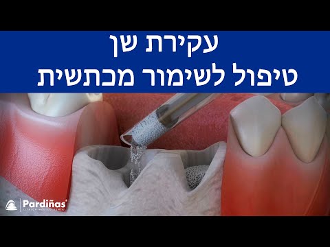 © עקירת שן – טיפול לשימור מכתשית