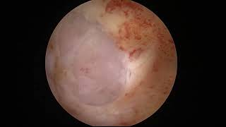 Hysteroscopic & Laparoscopic Multiple Myomectomy