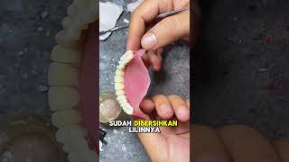 Download lagu Full Upper Jaw Acrylic Dentures mp3