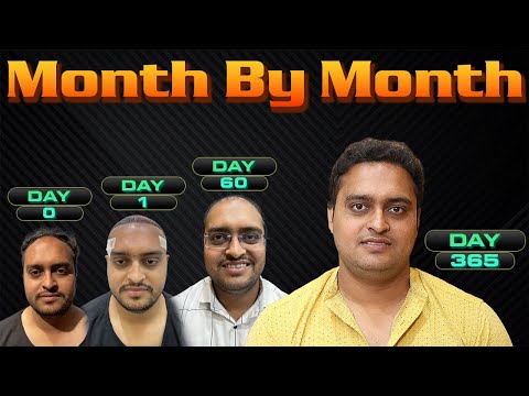 Hair Transplant Results Journey: Month by Month !!!