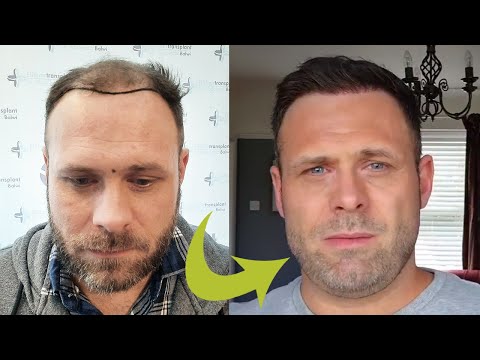 Michael´s Complete Hair Transplant Story