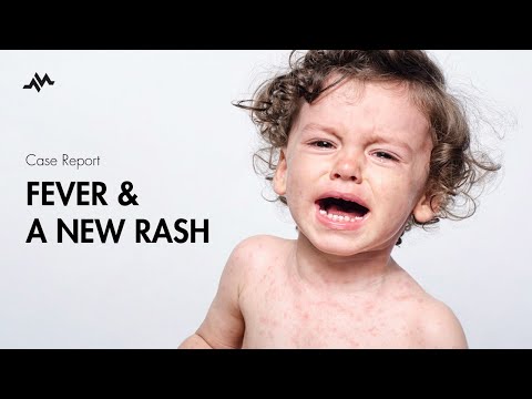 Pediatric Fever and Rash - Case Report