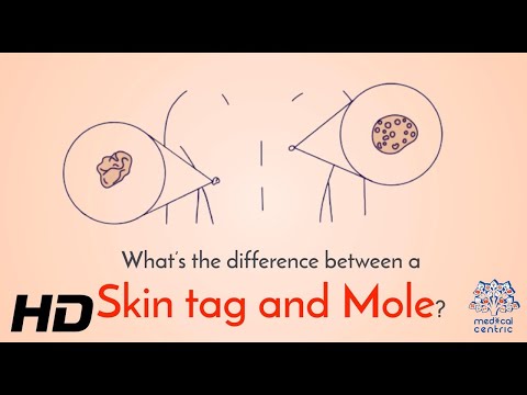 Decoding Skin Bumps: Mole vs. Skin Tag - Know the Difference!